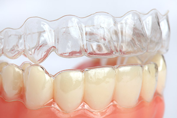 Invisalign® Treatment: What You Should Know